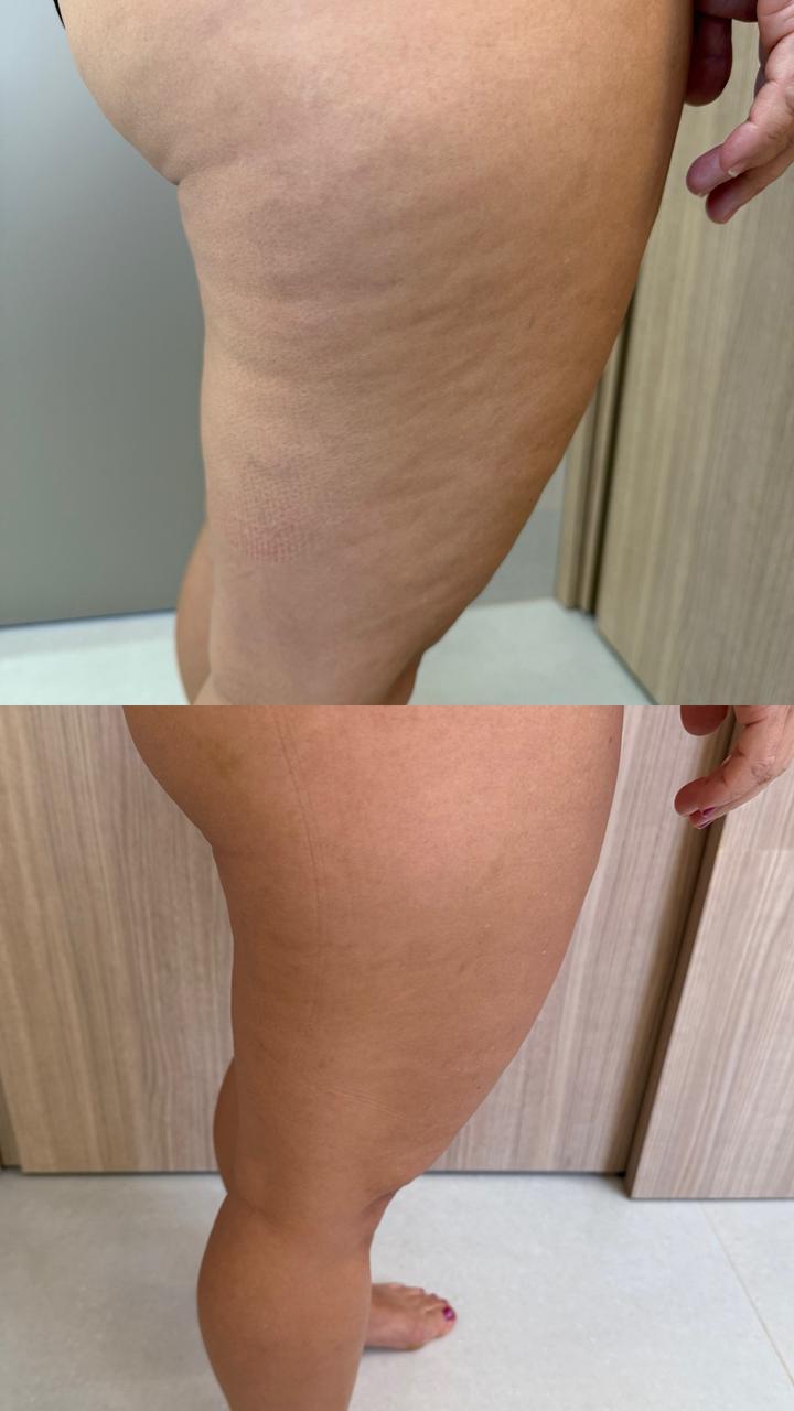 Registro clínico de evolução de paciente com lipedema, vista lateral, sem identificação.