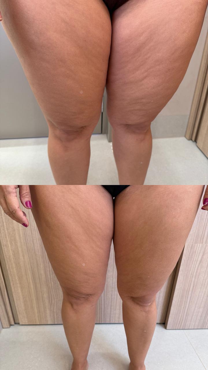 Registro clínico de evolução de paciente com lipedema, vista frontal, sem identificação.
