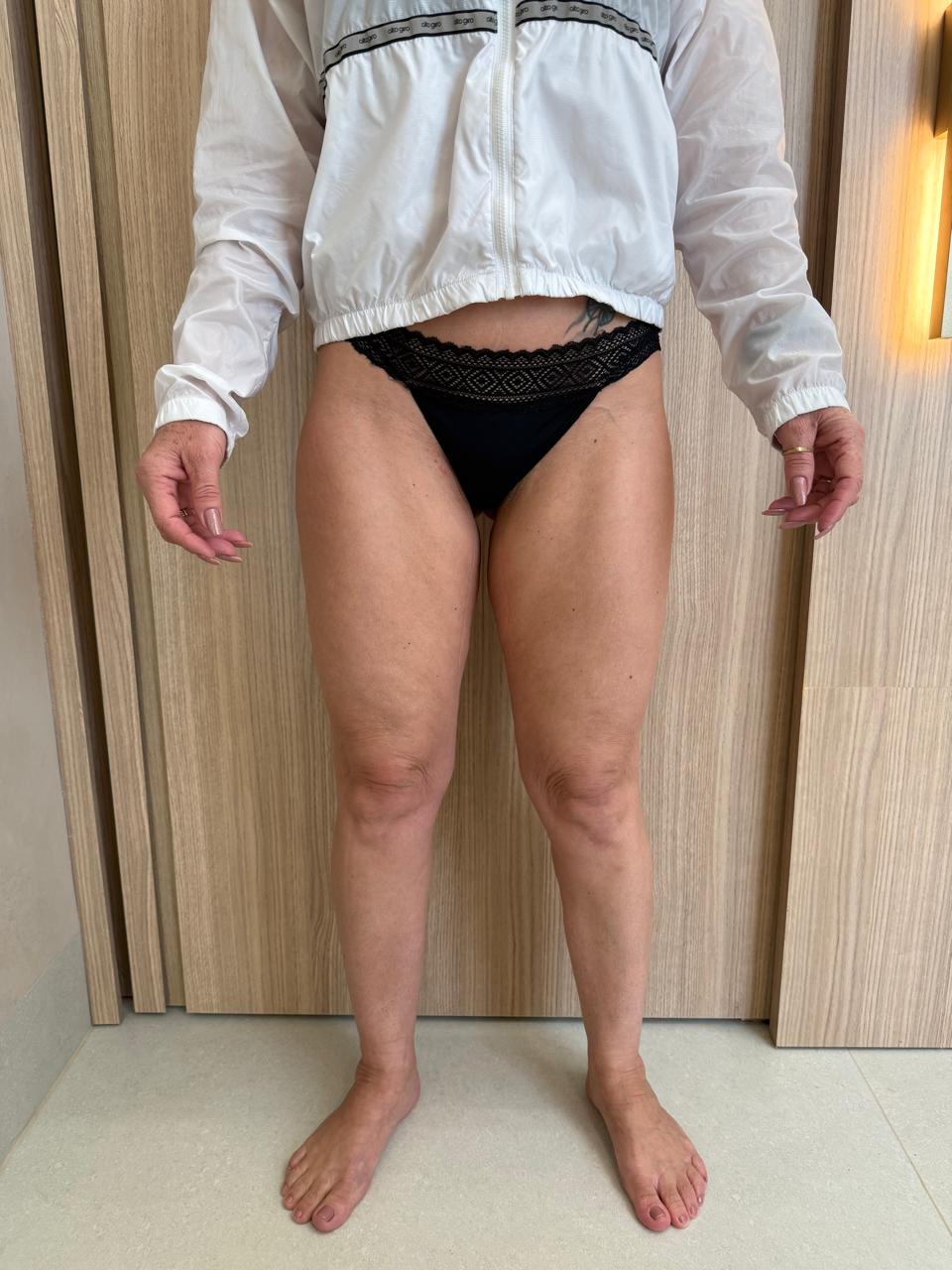 Depois — vista frontal após acompanhamento de lipedema, menopausa e emagrecimento, sem identificação.
