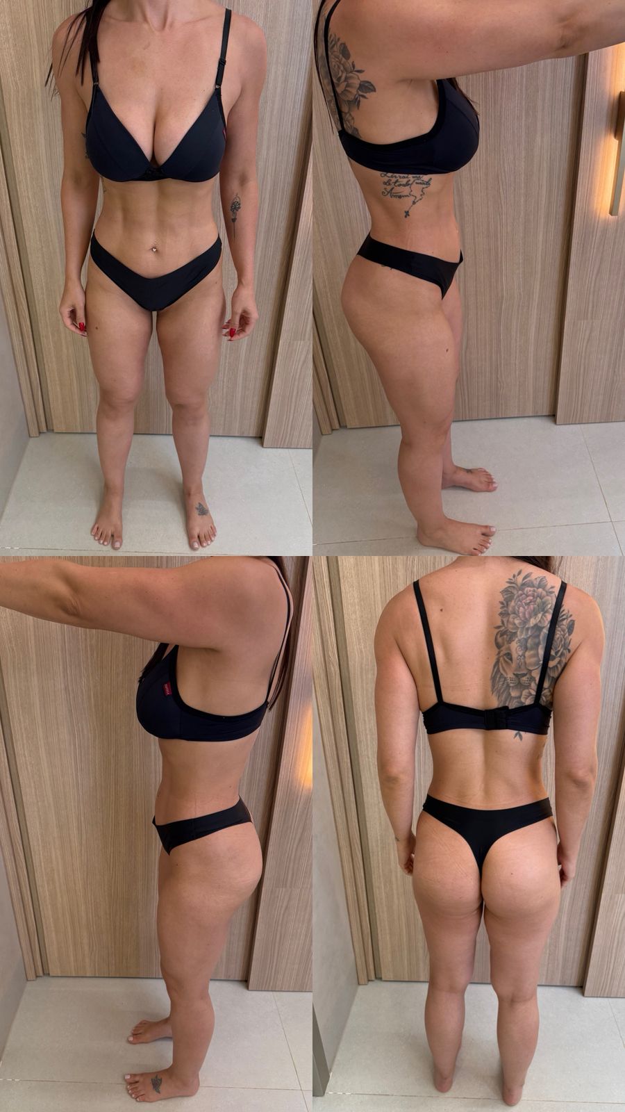Registro clínico em quatro vistas após acompanhamento de emagrecimento e lipedema.