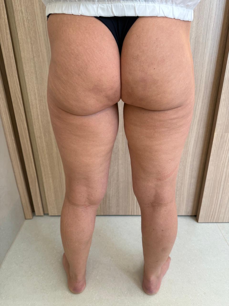 Depois — vista posterior após acompanhamento de lipedema, menopausa e emagrecimento, sem identificação.