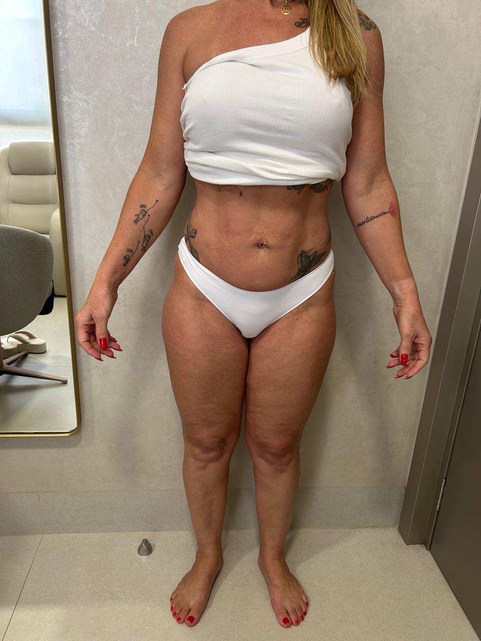 Antes — vista frontal de paciente em acompanhamento de lipedema, menopausa e emagrecimento, sem identificação.